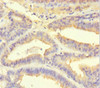 Immunohistochemistry of paraffin-embedded human endometrial cancer using CSB-PA852882HA01HU at dilution of 1:100
