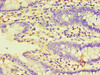 Immunohistochemistry of paraffin-embedded human colon cancer using CSB-PA853412LA01HU at dilution of 1:100