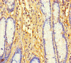 Immunohistochemistry of paraffin-embedded human gastric cancer using CSB-PA853422LA01HU at dilution of 1:100