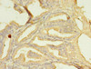 Immunohistochemistry of paraffin-embedded human prostate cancer using CSB-PA853470LA01HU at dilution of 1:100