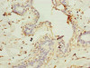 Immunohistochemistry of paraffin-embedded human breast cancer using CSB-PA855035LA01HU at dilution of 1:100