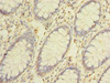 Immunohistochemistry of paraffin-embedded human colon cancer using CSB-PA855035LA01HU at dilution of 1:100