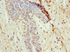 Immunohistochemistry of paraffin-embedded human breast cancer using CSB-PA855041LA01HU at dilution of 1:100
