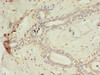 Immunohistochemistry of paraffin-embedded human breast cancer using CSB-PA855488LA01HU at dilution of 1:100