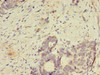 Immunohistochemistry of paraffin-embedded human gastric cancer using CSB-PA855490LA01HU at dilution of 1:100