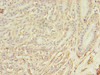 Immunohistochemistry of paraffin-embedded human breast cancer using CSB-PA855501LA01HU at dilution of 1:100