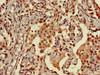 Immunohistochemistry of paraffin-embedded human lung cancer using CSB-PA856441LA01HU at dilution of 1:100