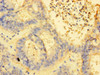 Immunohistochemistry of paraffin-embedded human endometrial cancer using CSB-PA856920LA01HU at dilution of 1:100