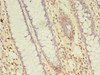 Immunohistochemistry of paraffin-embedded human colon cancer using CSB-PA856950LA01HU at dilution of 1:100