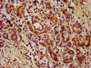 IHC image of CSB-PA860344LA01HU diluted at 1:1000 and staining in paraffin-embedded human pancreatic cancer performed on a Leica BondTM system. After dewaxing and hydration, antigen retrieval was mediated by high pressure in a citrate buffer (pH 6.0) . Section was blocked with 10% normal goat serum 30min at RT. Then primary antibody (1% BSA) was incubated at 4°C overnight. The primary is detected by a biotinylated secondary antibody and visualized using an HRP conjugated SP system.