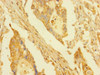 Immunohistochemistry of paraffin-embedded human pancreatic cancer using CSB-PA861193LA01HU at dilution of 1:100