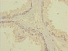Immunohistochemistry of paraffin-embedded human prostate cancer using CSB-PA862040LA01HU at dilution of 1:100