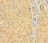 Immunohistochemistry of paraffin-embedded human liver cancer using CSB-PA862041LA01HU at dilution of 1:100