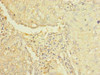 Immunohistochemistry of paraffin-embedded human lung cancer using CSB-PA863119LA01HU at dilution of 1:100
