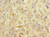 Immunohistochemistry of paraffin-embedded human melanoma using CSB-PA863964LA01HU at dilution of 1:100