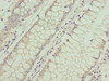 Immunohistochemistry of paraffin-embedded human colon cancer using CSB-PA863988LA01HU at dilution of 1:100 Immunohistochemistry of paraffin-embedded human colon cancer using CSB-PA863988LA01HU at dilution of 1:100