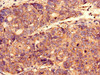 Immunocytochemistry analysis of human gastric cancer using CSB-PA865117EA01HU at dilution of 1:100