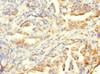 Immunohistochemistry of paraffin-embedded human lung cancer using CSB-PA865161LA01HU at dilution of 1:100