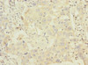 Immunohistochemistry of paraffin-embedded human liver cancer using CSB-PA865161LA01HU at dilution of 1:100