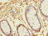 Immunohistochemistry of paraffin-embedded human colon cancer using CSB-PA866338LA01HU at dilution of 1:100