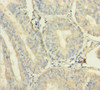 Immunohistochemistry of paraffin-embedded human endometrial cancer using CSB-PA867163LA01HU at dilution of 1:100