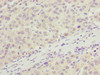 Immunohistochemistry of paraffin-embedded human liver cancer using CSB-PA867178LA01HU at dilution of 1:100