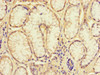 Immunohistochemistry of paraffin-embedded human gastric cancer using CSB-PA868283LA01HU at dilution of 1:100