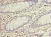 Immunohistochemistry of paraffin-embedded human colon cancer using CSB-PA871585LA01HU at dilution of 1:100 Immunohistochemistry of paraffin-embedded human colon cancer using CSB-PA871585LA01HU at dilution of 1:100