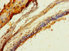 Immunohistochemistry of paraffin-embedded human breast cancer using CSB-PA873727LA01HU at dilution of 1:100