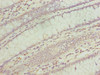 Immunohistochemistry of paraffin-embedded human colon cancer using CSB-PA874810LA01HU at dilution of 1:100 Immunohistochemistry of paraffin-embedded human colon cancer using CSB-PA874810LA01HU at dilution of 1:100