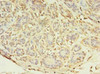 Immunohistochemistry of paraffin-embedded human breast cancer using CSB-PA874812LA01HU at dilution of 1:100