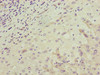 Immunohistochemistry of paraffin-embedded human liver cancer using CSB-PA875629LA01HU at dilution of 1:100