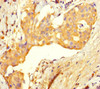 Immunohistochemistry of paraffin-embedded human breast cancer using CSB-PA878841LA01HU at dilution of 1:100