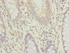 Immunohistochemistry of paraffin-embedded human colon cancer using CSB-PA878854HA01HU at dilution of 1:100 Immunohistochemistry of paraffin-embedded human colon cancer using CSB-PA878854HA01HU at dilution of 1:100