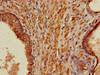 Immunohistochemistry of paraffin-embedded human prostate cancer using CSB-PA878855LA01HU at dilution of 1:100