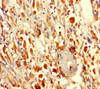 Immunohistochemistry of paraffin-embedded human melanoma using CSB-PA878875LA01HU at dilution of 1:100