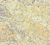 Immunohistochemistry of paraffin-embedded human cervical cancer using CSB-PA878881LA01HU at dilution of 1:100