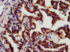 IHC image of CSB-PA878944LA01HU diluted at 1:800 and staining in paraffin-embedded human lung cancer performed on a Leica BondTM system. After dewaxing and hydration, antigen retrieval was mediated by high pressure in a citrate buffer (pH 6.0) . Section was blocked with 10% normal goat serum 30min at RT. Then primary antibody (1% BSA) was incubated at 4°C overnight. The primary is detected by a biotinylated secondary antibody and visualized using an HRP conjugated SP system.