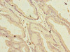 Immunohistochemistry of paraffin-embedded human prostate cancer using CSB-PA878960LA01HU at dilution of 1:100