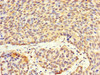 Immunohistochemistry of paraffin-embedded human ovarian cancer using CSB-PA882062LA01HU at dilution of 1:100