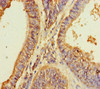 Immunohistochemistry of paraffin-embedded human endometrial cancer using CSB-PA882095LA01HU at dilution of 1:100