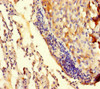 Immunohistochemistry of paraffin-embedded human lung cancer using CSB-PA883416LA01HU at dilution of 1:100
