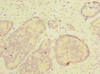 Immunohistochemistry of paraffin-embedded human gastric cancer using CSB-PA883600LA01HU at dilution of 1:100