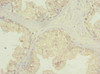 Immunohistochemistry of paraffin-embedded human prostate cancer using CSB-PA883611LA01HU at dilution of 1:100
