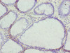 Immunohistochemistry of paraffin-embedded human colon cancer using CSB-PA883633LA01HU at dilution of 1:100