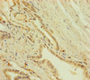 Immunohistochemistry of paraffin-embedded human prostate cancer using CSB-PA885697LA01HU at dilution of 1:100