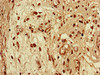 Immunohistochemistry of paraffin-embedded human lung cancer using CSB-PA887012LA01HU at dilution of 1:100