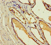 Immunohistochemistry of paraffin-embedded human prostate cancer using CSB-PA887950LA01HU at dilution of 1:100