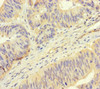 Immunohistochemistry of paraffin-embedded human colon cancer using CSB-PA888012LA01HU at dilution of 1:100 Immunohistochemistry of paraffin-embedded human colon cancer using CSB-PA888012LA01HU at dilution of 1:100