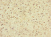 Immunohistochemistry of paraffin-embedded human glioma using CSB-PA888027LA01HU at dilution of 1:100 Immunohistochemistry of paraffin-embedded human glioma using CSB-PA888027LA01HU at dilution of 1:100